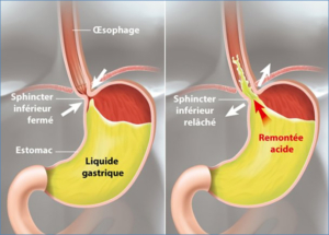 brûlures d'estomac